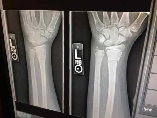 Have you ever broken a bone?